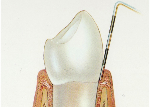 Parodontologie : gingivite et parodontite