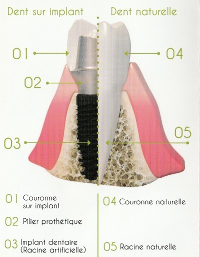 Implantologie : Implants Dentaires