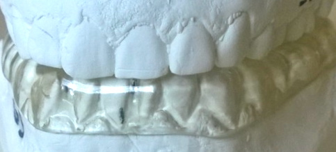 Bruxisme :  grincement des dents