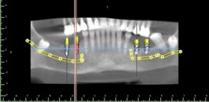 implant implantologie scanner cone beam vue panoramique cabinet dentaire ludovic ha dentiste anglet blanpignon