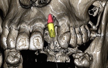 Implant : (r)évolution numérique