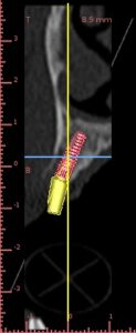 implant implantologie scanner cone beam coupe cabinet dentaire ludovic ha dentiste anglet blancpignon
