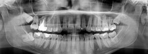dent de sagesse enclavée incluse extraction germe cabinet dentaire du docteur ludovic ha chirurgien dentiste anglet blancpignon biarritz bayonne