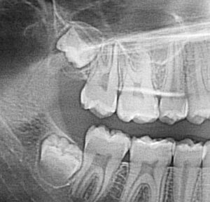 dent de sagesse enclavée incluse extraction germe cabinet dentaire du docteur ludovic ha chirurgien dentiste panoramique owandy anglet blancpignon biarritz bayonne