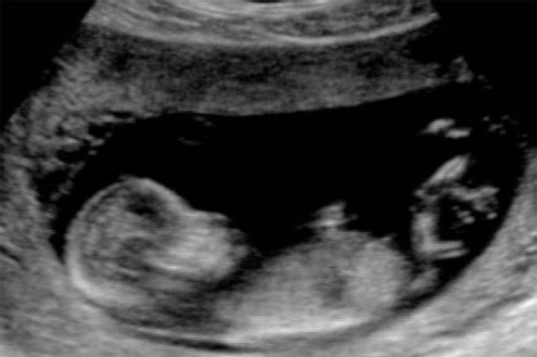 Grossesse et santé bucco-dentaire