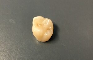 couronne dentaire zircone céramique prothèse esthétique cabinet docteur ludovic ha anglet biarritz bayonne pays basque blancpignon